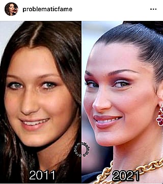 Bella Hadid before surgery. She’s not a nice person, either.'