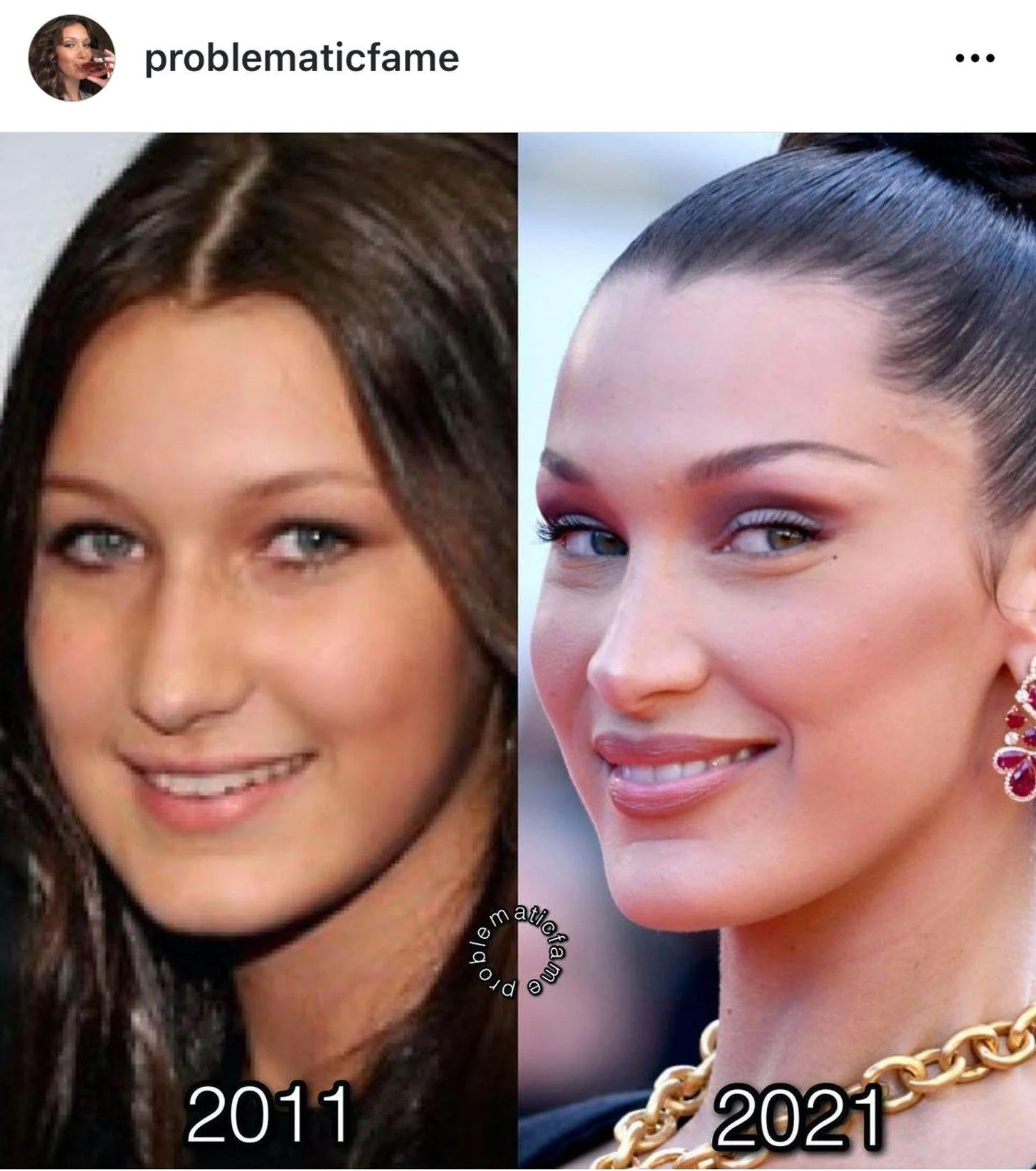 Bella Hadid before surgery. She’s not a nice person, either. picture 1 of 1